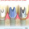 راهنمای مراحل کلینیکی و لابراتواری انتخاب و آماده سازی اباتمنت ایمپلنت های دندانی