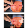 Facial Paralysis A Comprehensive Rehabilitative Approach