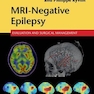 MRI-Negative Epilepsy: Evaluation and Surgical Management