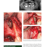 Dental Implant Complications: Etiology, Prevention, and Treatment 2nd Edition