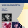 Breast Cancer: Early Detection with Mammography: Crushed Stone-like Calcifications: The Most Frequent Malignant Type 1st Edicion 2008