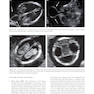 Ultrasound of Congenital Fetal Anomalies 2nd Edition2014