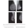 LANGE Q-A: Mammography Examination, 5th Edition 2022