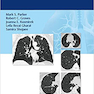 Lung Cancer Screening 1st Edition2017 غربالگری سرطان ریه