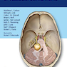 Comprehensive Management of Vestibular Schwannoma 1st Edition2019 مدیریت جامع شوانوم دهلیزی