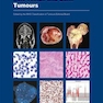 WHO classification of tumours of soft tissue and bone tumours 2020