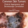 Diagnosing the Less Common Skin Tumors : Clinical Appearance and Dermoscopy Correlation2019