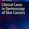 Clinical Cases in Dermoscopy of Skin Cancersموارد بالینی درموسکوپی سرطانهای پوست