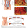 Atlas of Abdominoplasty