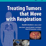 جراحی رادیویی درمان تومورهایی که با تنفس حرکت می کنند
