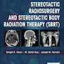 رادیوتراپی استریوتاکتیک و پرتودرمانی استریوتاکتیک بدن