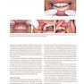 Dermal Fillers for Dental Professionals