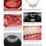 Color Atlas of Dental Implant Surgery 4th Edicion 2015