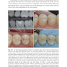 Management of Deep Carious Lesions 2018