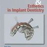 Immediate Function and Esthetic in Implant Dentistry