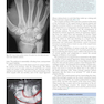 Plastic Surgery Volume 6: Hand and Upper Limb 4th Edicion 2018