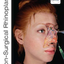 Non-Surgical Rhinoplasty (The PRIME Series) Kindle Edition