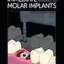 Immediate Molar Implants Kindle Edition
