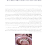 عوارض پیچیده ایمپلنت های دندانی