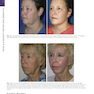 The Art and Science of Facelift Surgery 2nd Edition 2024