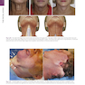 The Art and Science of Facelift Surgery 2nd Edition 2024