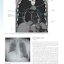 Sabiston and Spencer Surgery of the Chest 10th Edition