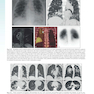 Sabiston and Spencer Surgery of the Chest 10th Edition